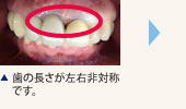 歯の長さが左右非対称です。